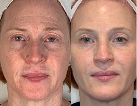 Microneedle rf treatment before after
