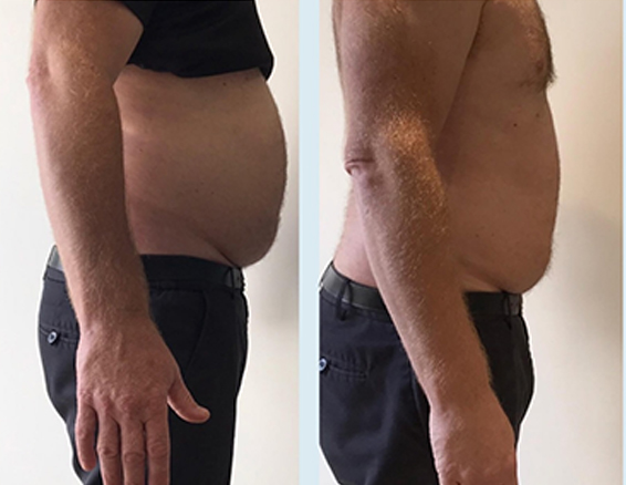 10D emerald laser before after