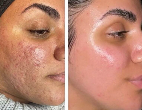 Microneedle rf treatment before after