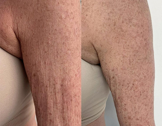hifu machine before after