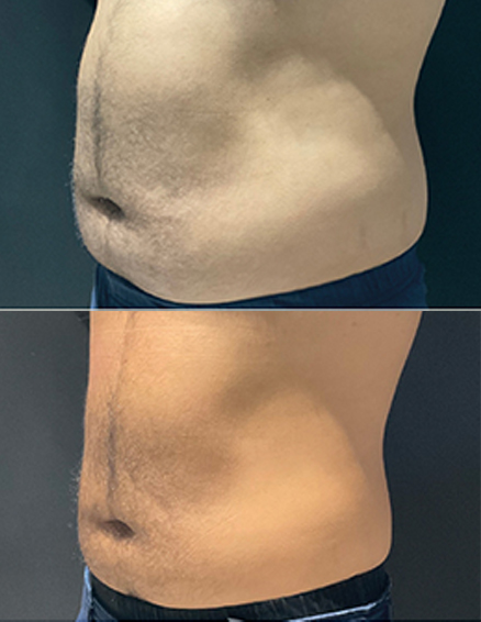10D emerald laser before after