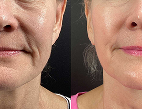 Microneedle rf treatment before after