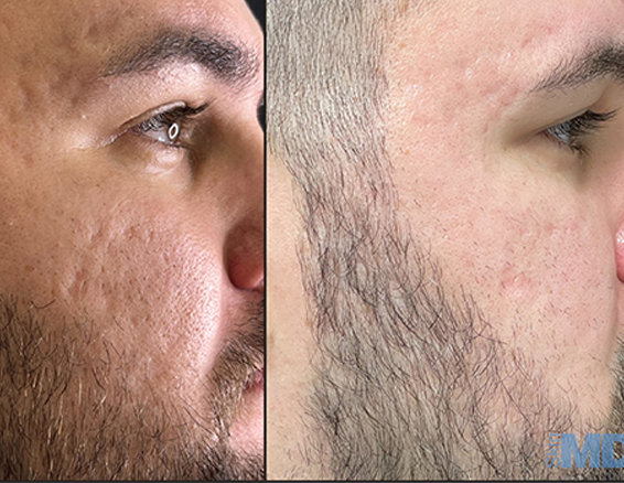BA-FC22-portable fractional co2 laser before after