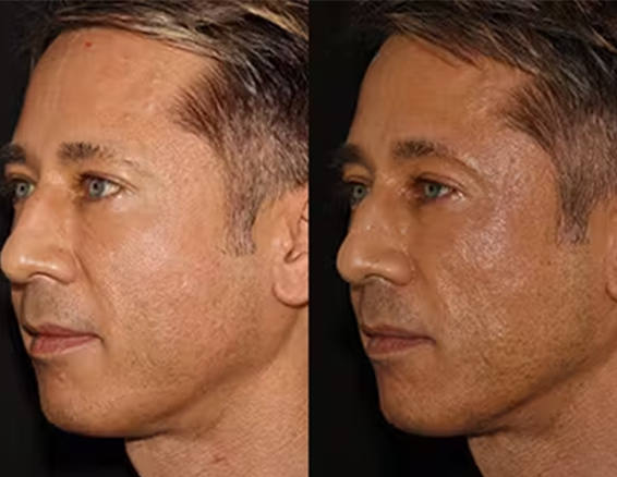 ems rf facial machine before after