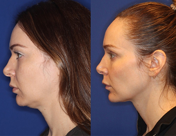 ems rf facial machine before after