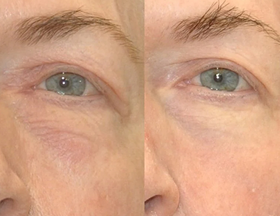 BA-FC22-portable fractional co2 laser before after