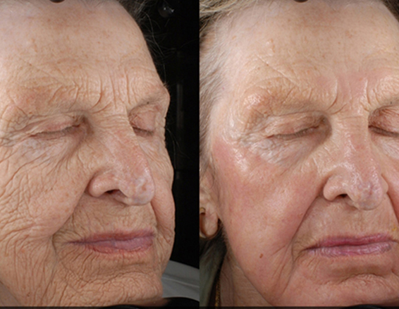BA-FC22-portable fractional co2 laser before after