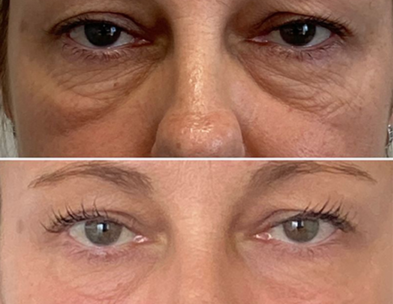 Microneedle rf treatment before after