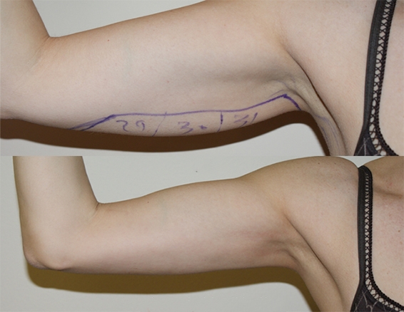 velashape before after