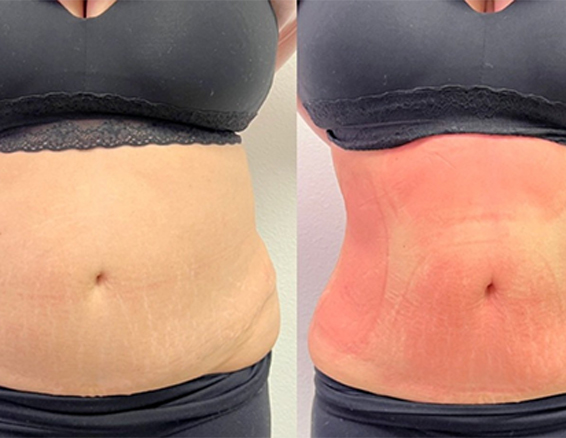 BA-CR21 fat freezing machine before after
