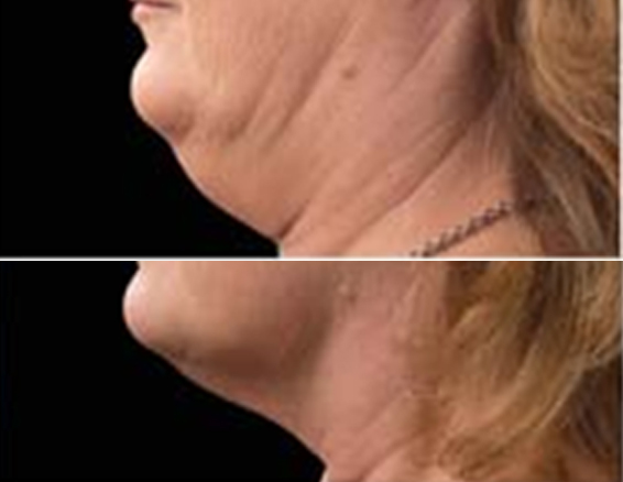 BA-CR21 fat freezing machine before after