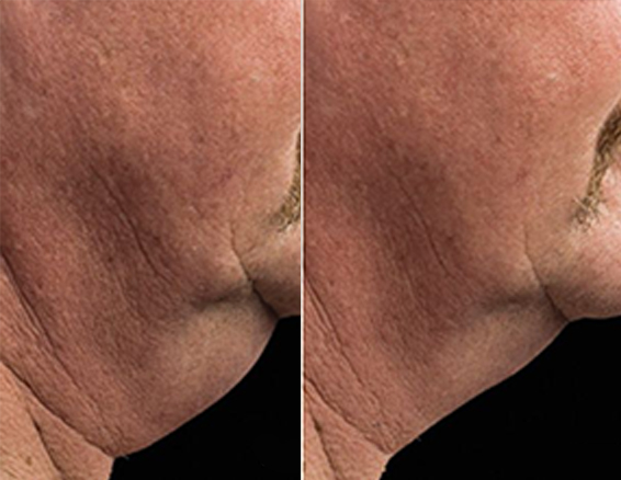 before after