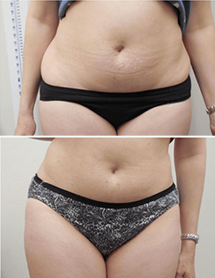 10D emerald laser before after