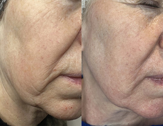 fractional co2 laser treatment before after