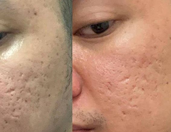 fractional co2 laser treatment before after