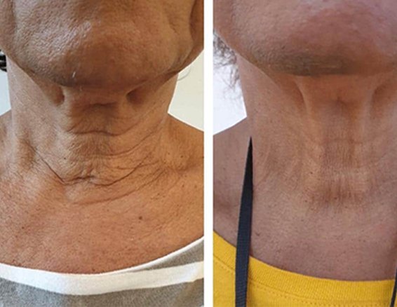 hifu machine before after