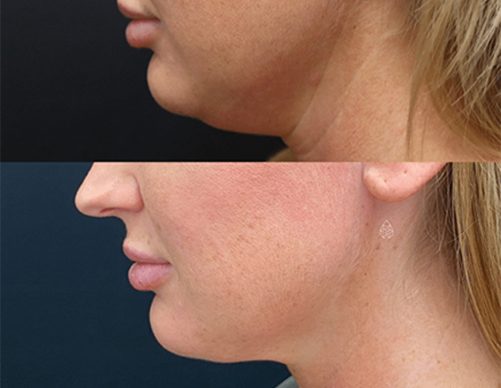 before after