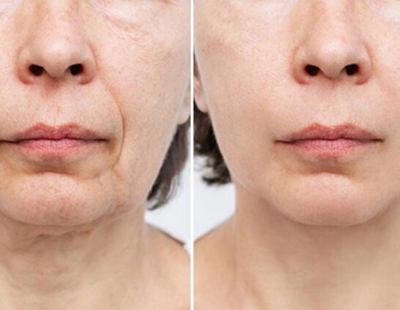 fractional co2 laser treatment before after