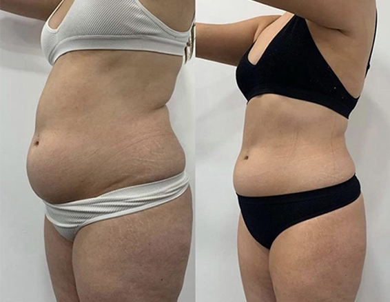 10D emerald laser before after