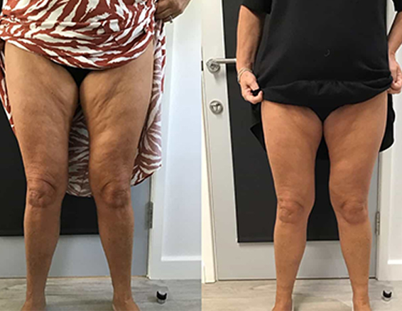 hifu machine before after