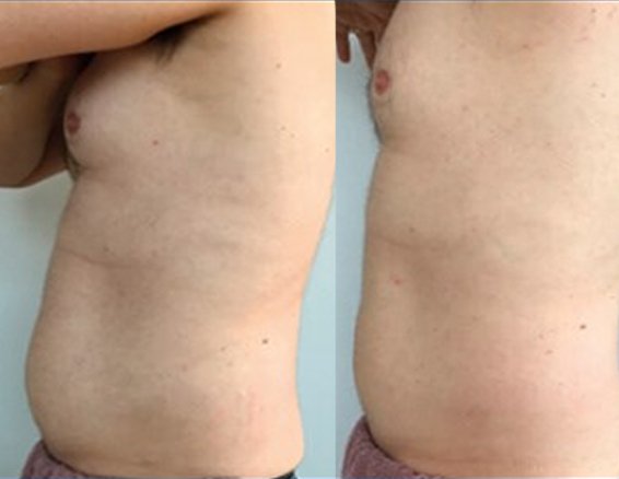 before after