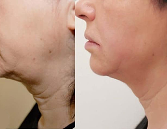 hifu machine before after