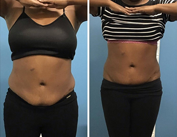 10D emerald laser before after