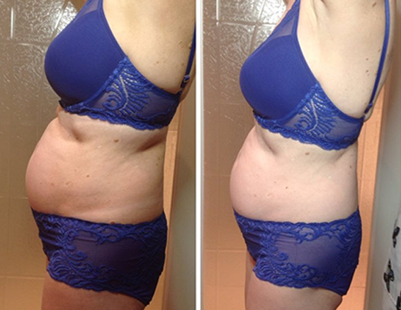 velashape before after