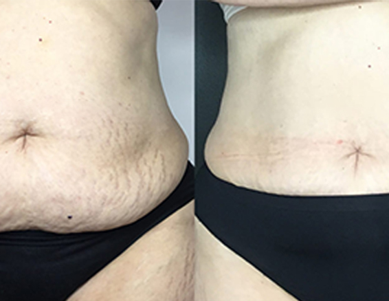 hifu machine before after