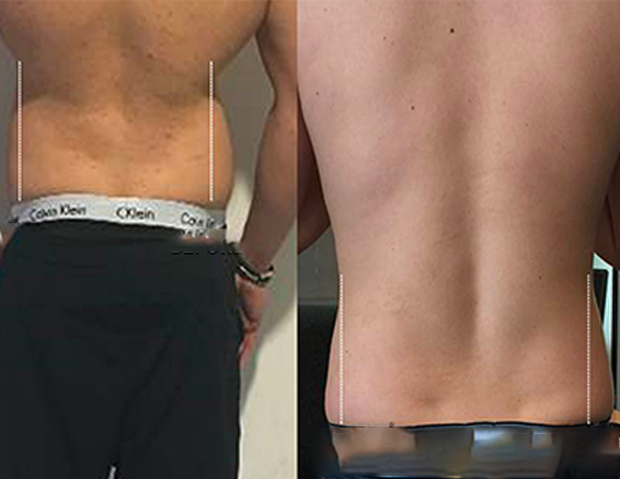 hifu machine before after
