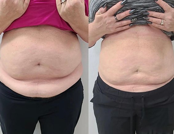 10D emerald laser before after