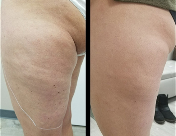 velashape before after