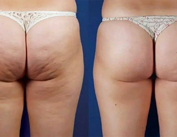 velashape before after