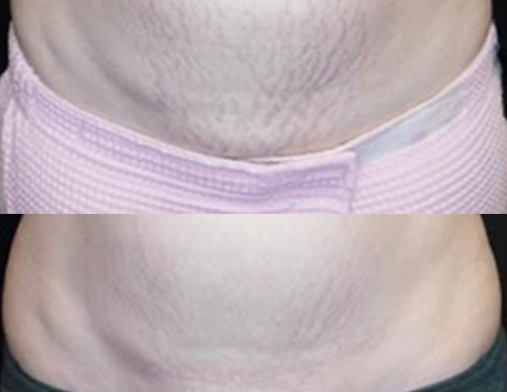 Microneedle rf treatment before after