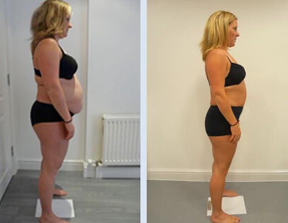 BA-CR21 fat freezing machine before after