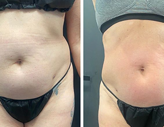 velashape before after