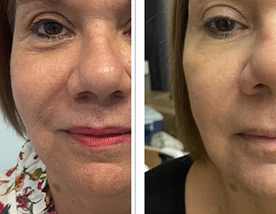velashape before after