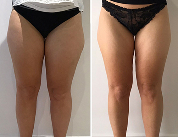 10D emerald laser before after