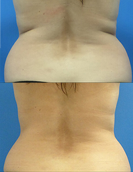 10D emerald laser before after