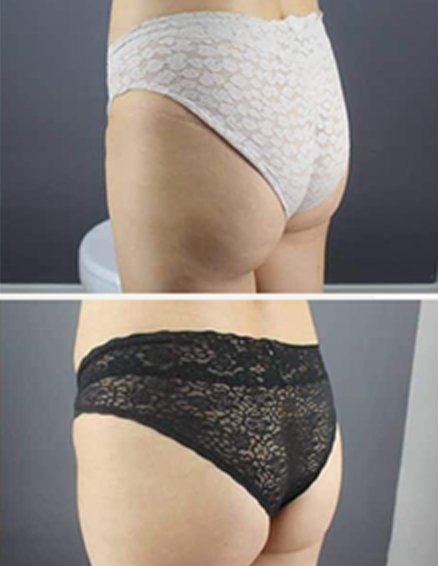 emszero before after