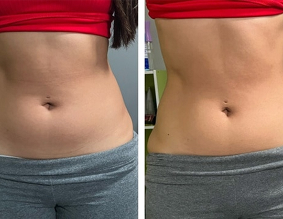 10D emerald laser before after