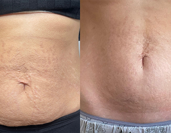 Microneedle rf treatment before after