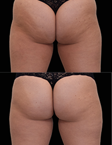 emszero treatment before after