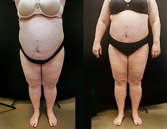 10D emerald laser before after
