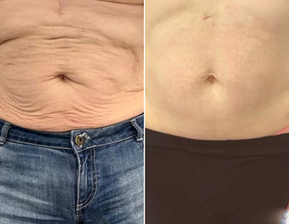Microneedle rf treatment before after