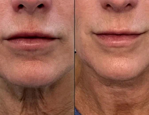ems rf facial machine before after