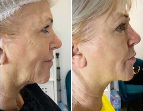 hifu machine before after