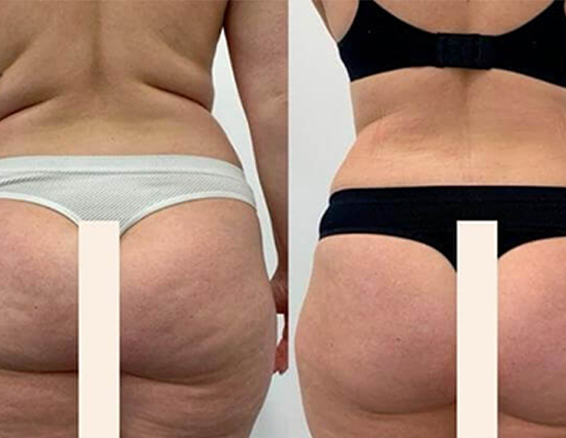 10D emerald laser before after