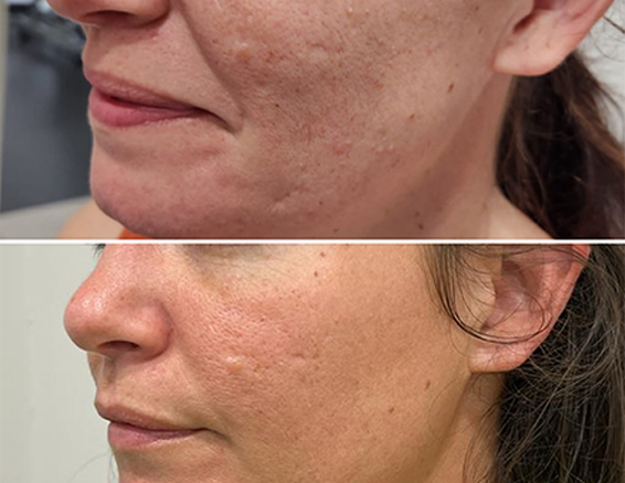 Microneedle rf treatment before after
