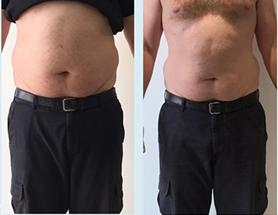10D emerald laser before after